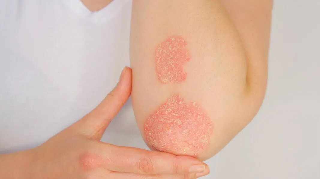 L.E.M.Q Peau soyeuse Psoriasis